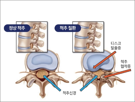 척추내시경 적응증