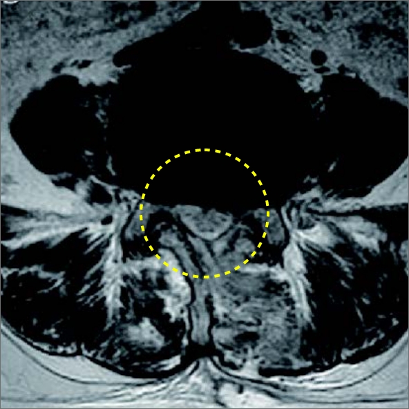 척추내시경 후 MRI