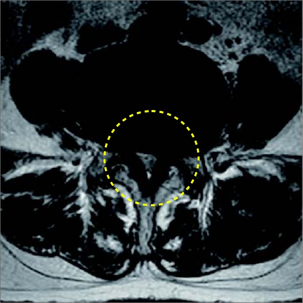 척추내시경 전 MRI